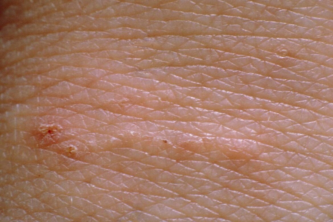 Understanding the Current Scabies Situation in the UK