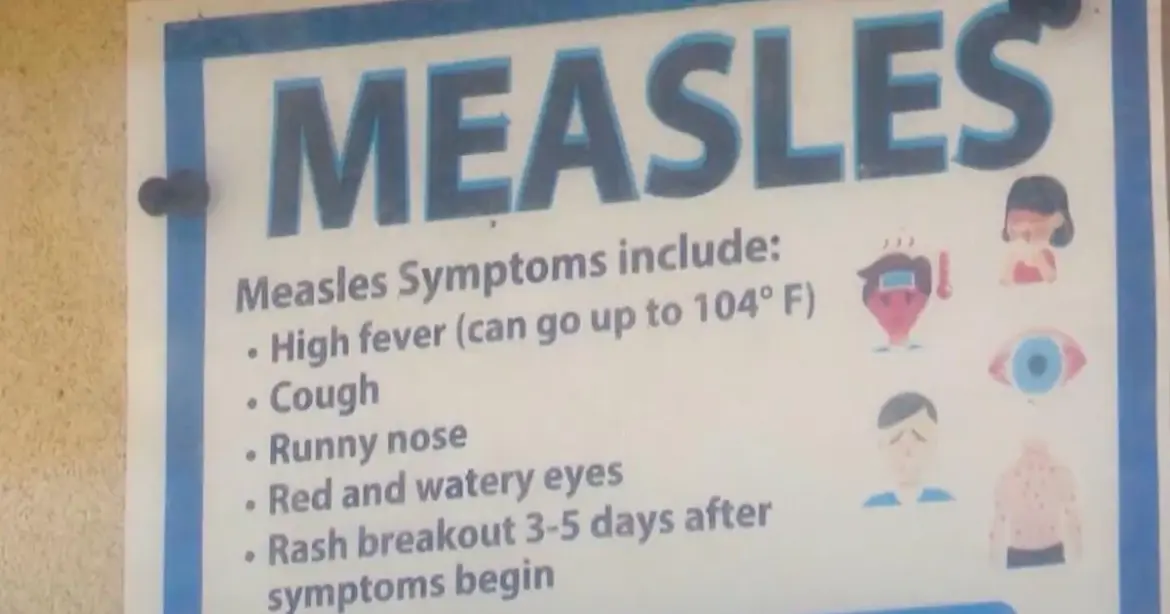 Recognising the Symptoms of Measles