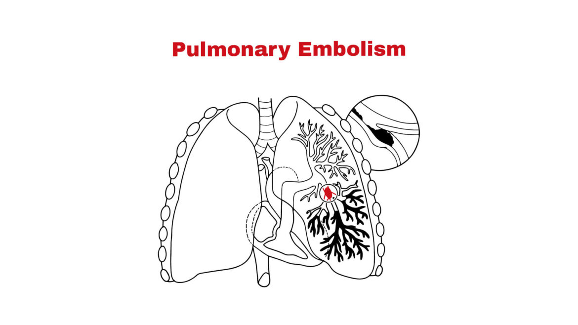All You Need to Know About Pulmonary Embolism